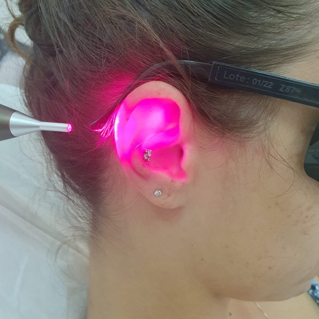 laserterapia piercing